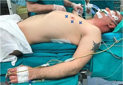 Learning Curve of Robot-Assisted Thymectomy: Single Surgeon's 7-Year Experience